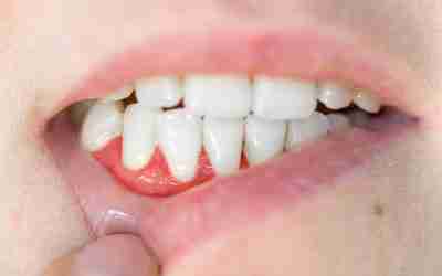 Early Signs of Gum Disease You Shouldn’t Ignore